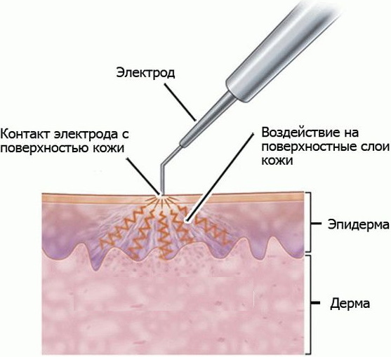 Removal of moles by electrocoagulation. How and how to treat the wound