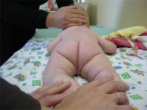 Profilaksis dan pengobatan displasia pinggul pada bayi baru lahir