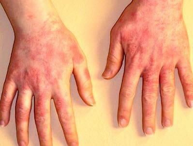 When treating dermatitis on hands, refrain from using hand cosmetics