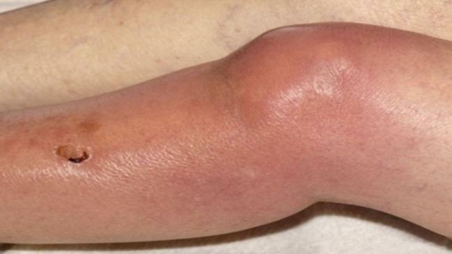 Infecțio-artrită alergică la copii