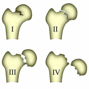 classification of hip fractures