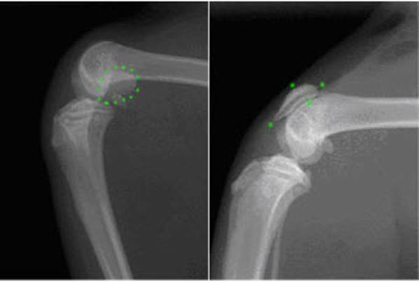 Roentgenogramas do joelho nas projeções laterais: a - deslocamento da patela;b - relação normal na articulação