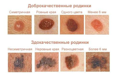 Differences of a malignant birthmark from benign