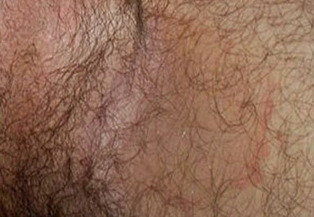 Behandling af inguinal epidermophytosis hos mænd, billeder af inguinalområdet