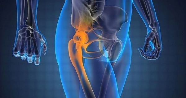 Coxartrosis de la articulación de la cadera de segundo grado. Tratamiento con remedios caseros, medicamentos, operación.