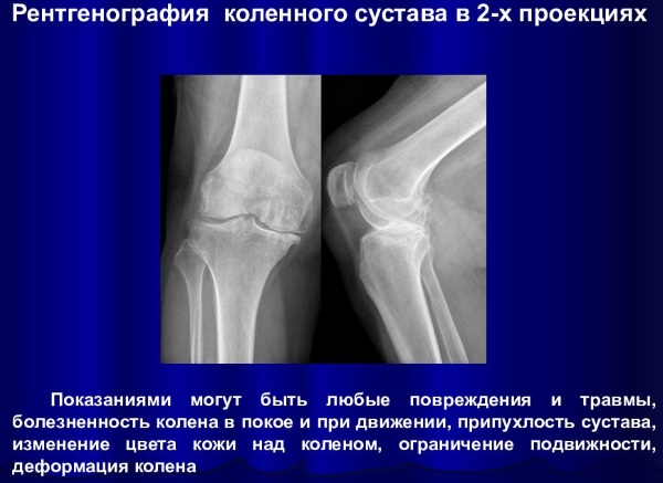 Røntgen af ​​knæleddet i to fremspring. Pris, som viser hvordan det er gjort
