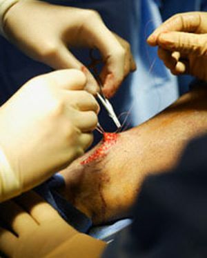 artroza zgloba koljena