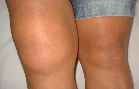 Las causas de la artritis de la articulación de la rodilla