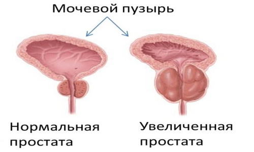 Enlarged prostate