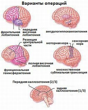 variants of operations for epilepsy