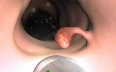 Prolapso gastroesofágico de la mucosa gástrica en el esófago: ¿qué es?