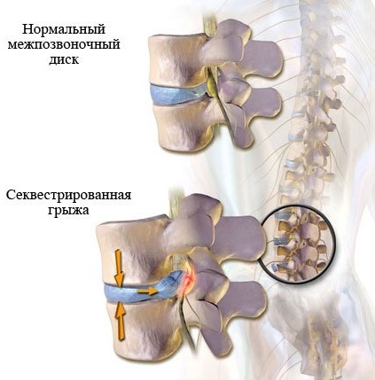 Sequestration of a herniated disc. What is it, symptoms, treatment