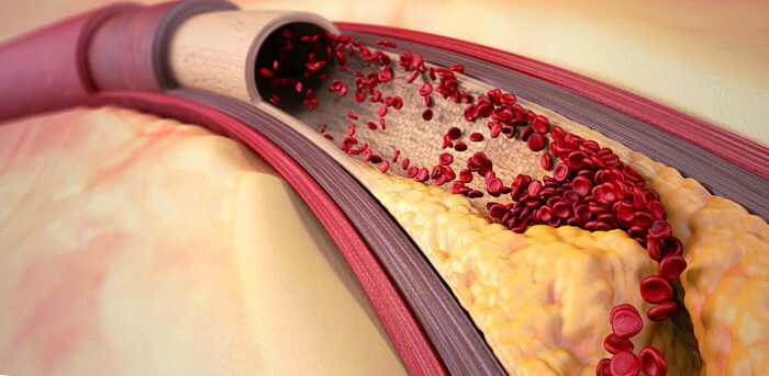 Atherosclerosis. Symptoms and signs, what is this disease