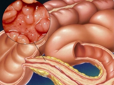 Colite do intestino: sintomas, tratamento em adultos, nutrição
