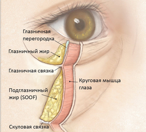 Hernia of the lower eyelid. Photo, how to remove without surgery, treatment