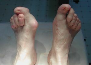Dislocazione delle dita dei piedi