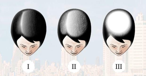 Stages of alopecia in women