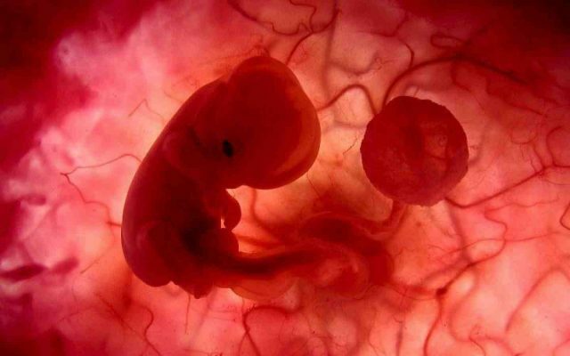 Intra-uteriene foetus