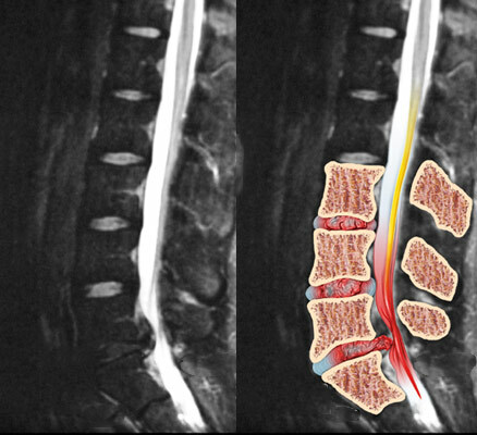 Ernia intervertebrale della colonna vertebrale lombosacrale