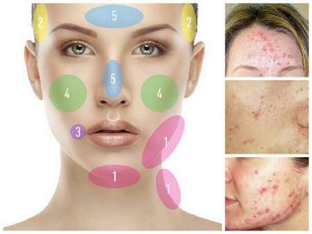 Acne on the face causes by zones