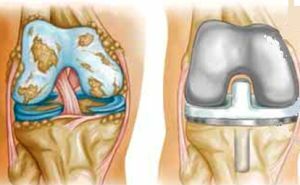 Prostesis lutut