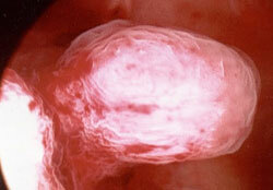 Tratamentul polipilor uterini