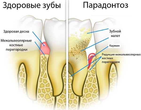 Sore gums. What to do after the removal, cleaning teeth, under the crowns, dentures, pregnancy