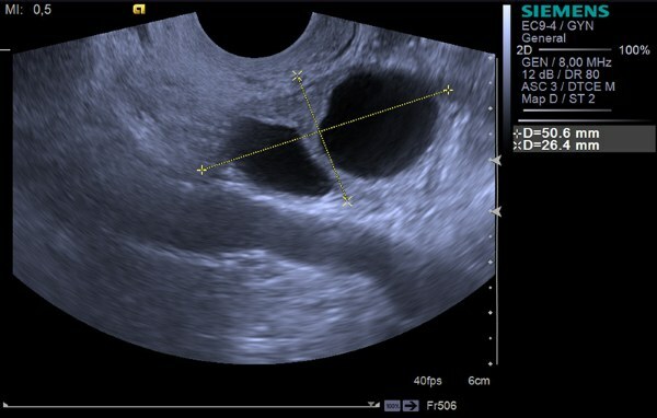 Colitis i nedre højre mave hos kvinder i nærheden af ​​bækkenbenet. Årsager
