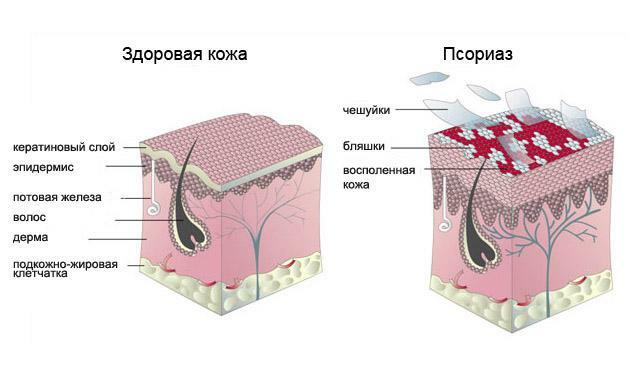 Treatment of psoriasis with medicines