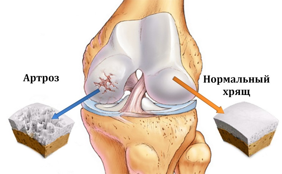 Schematic representation of the knee joint with arthrosis and normal cartilage