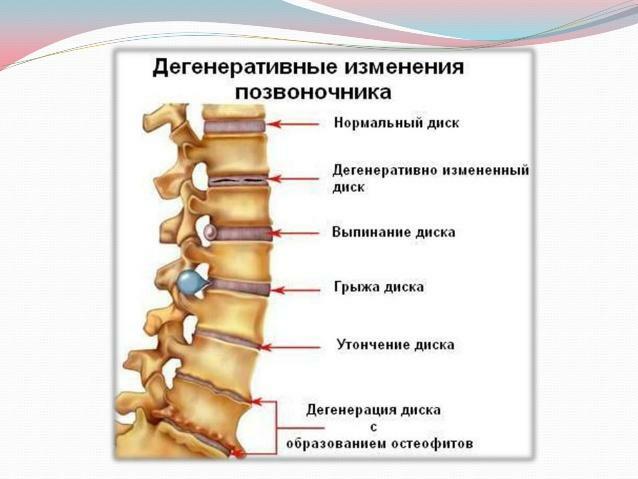 Modificări degenerative ale coloanei vertebrale