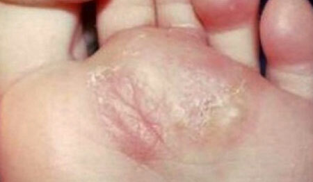 Signs of foot fungus