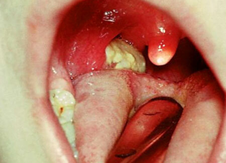 Type of throat with diphtheria, photo