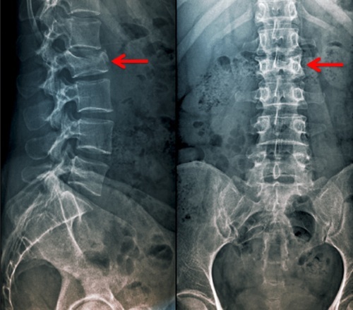 A compression fracture of the spine. What it is, treatment of the thoracic, lumbar, the elderly, children