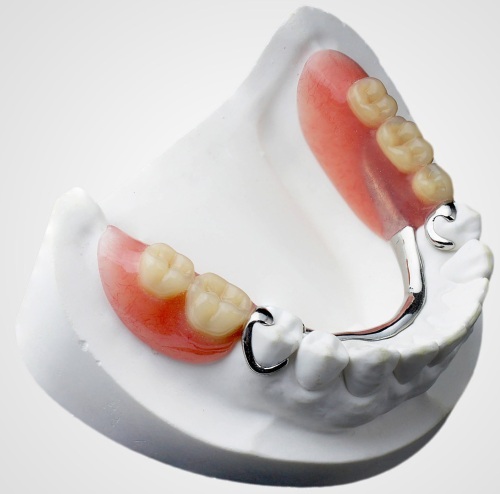 Clasp prostheses for the lower / upper jaw. Photo on clasps, attachments, locks, splinting, quadrotti