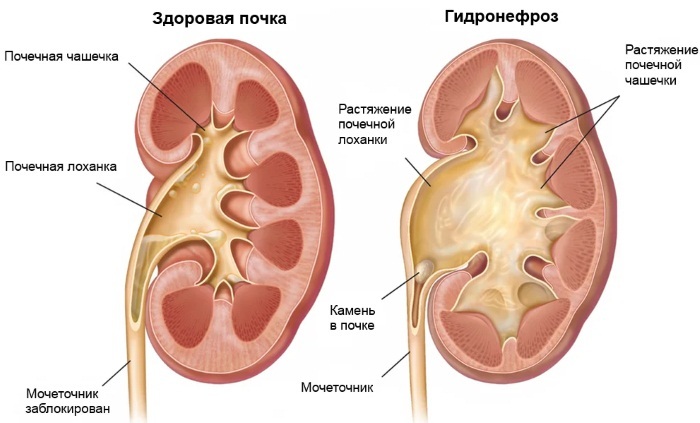 Pain in the kidneys from the back in men, women. Causes, treatment