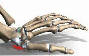 Treatment and rehabilitation after a fracture of the scaphoid bone of the hand