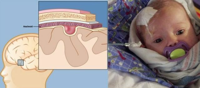 Eine enttäuschende Diagnose der Zyste des Gehirns bei einem Neugeborenen - wie kann man einem Säugling helfen?
