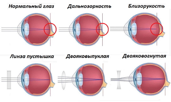 Contact lenses. Types, characteristics, terms of wearing