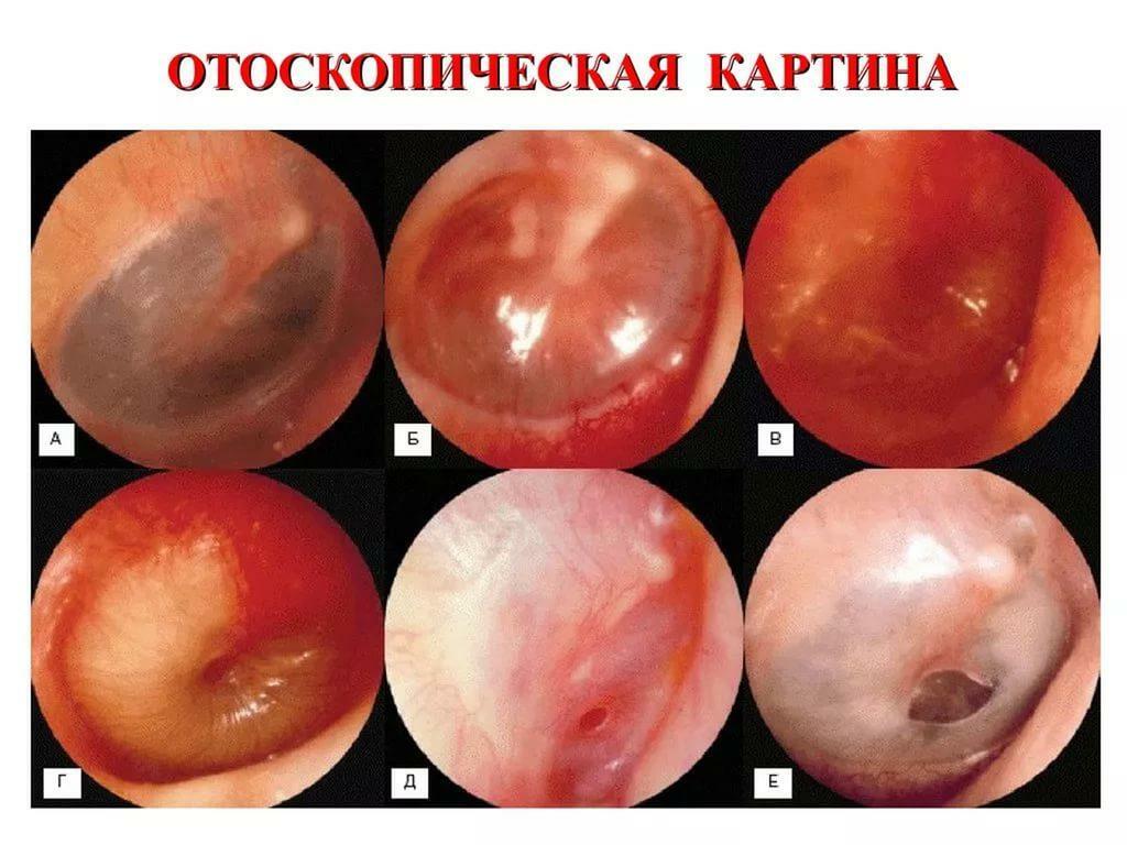 Otoskopisk bilde av otitis media i mellomøret