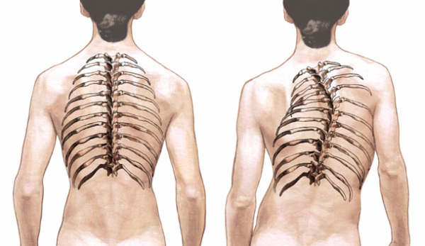 Scolioza coloanei vertebrale toracice