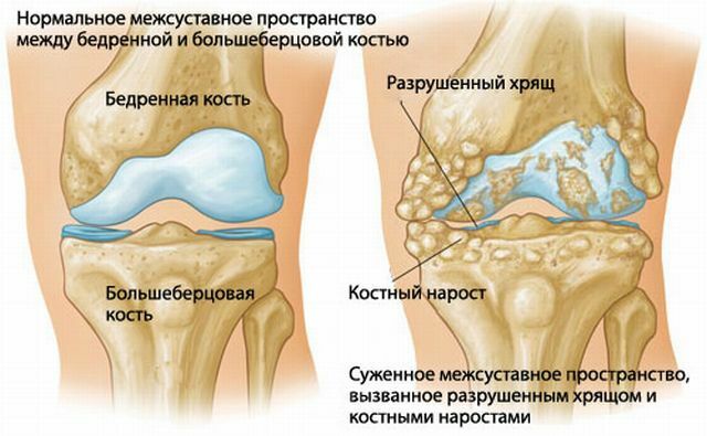 Årsager til betændelse i leddene på benene: behandling og forebyggelse