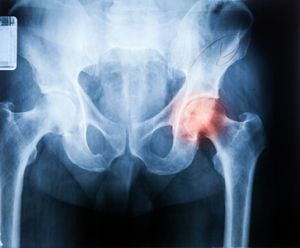 Hoe osteochondritis te voorkomen, te detecteren en te genezen?