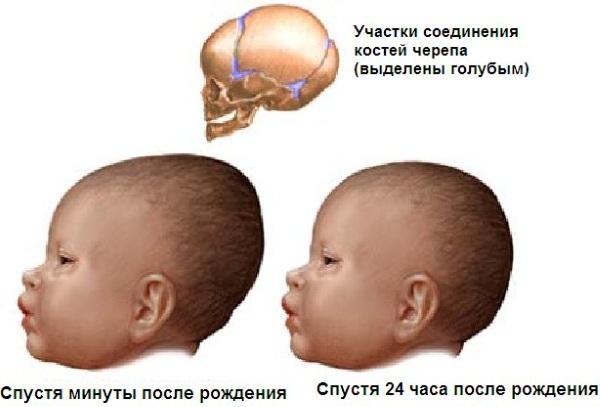 Suturer af kraniet hos en nyfødt. Fontanellernes størrelse er normal, anatomi, når den er vokset