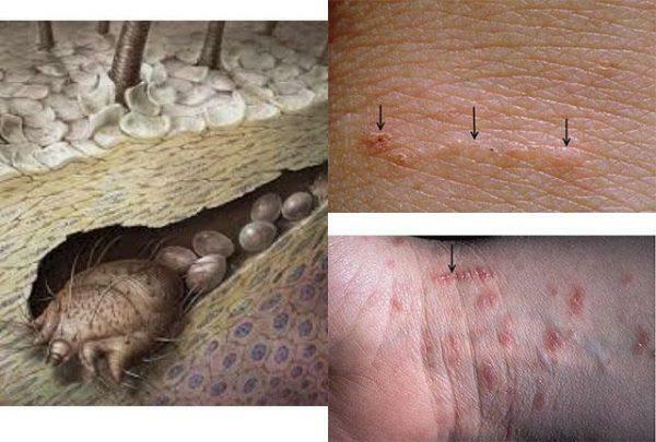 Manifestation av scabies mite på huden