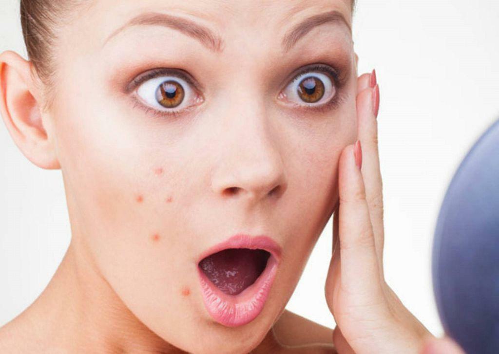 Acne on the cheeks of women: the cause