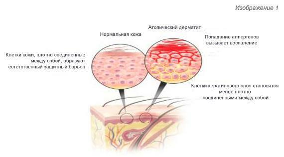 The onset of atopic dermatitis