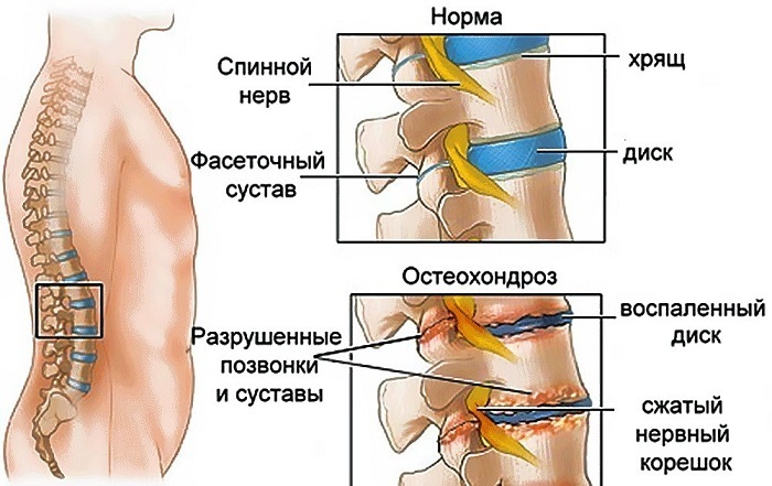 Cervical hernia. Symptoms and treatment without surgery with folk remedies, gymnastics, advice, psychosomatics