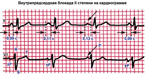 Deceleration of intra-atrial conduction on the ECG. Signs, causes, treatment