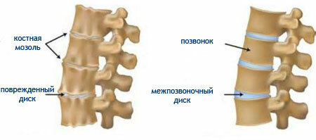 What is the spondylarthrosis of the lumbosacral spine?